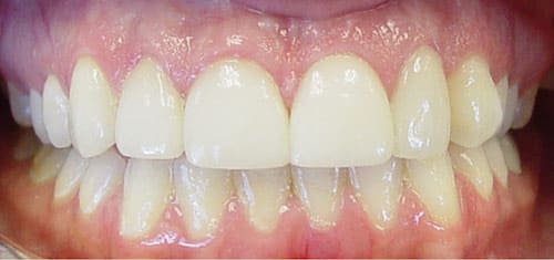 crown-lengthening-after-village-dental