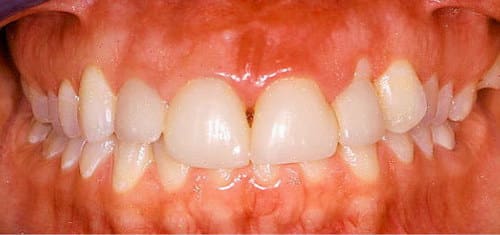 crown-lengthening-before-village-dental