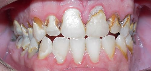 full-mouth-rehab-before-village-dental