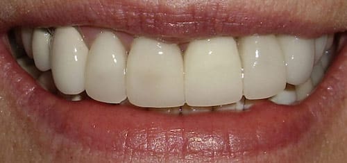 implant-and-crown-lengthening-after-village-dental