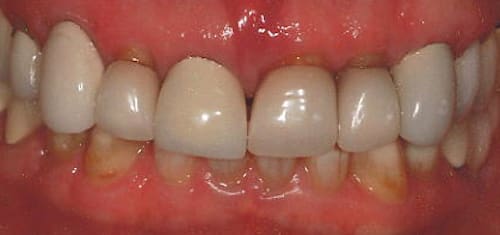 implant-and-crown-lengthening-before-village-dental