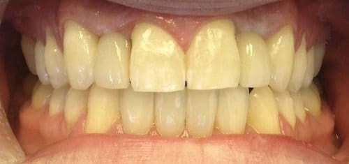 implants-invisalign-after-village-dental