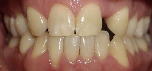 implants-invisalign-before-village-dental.jpeg