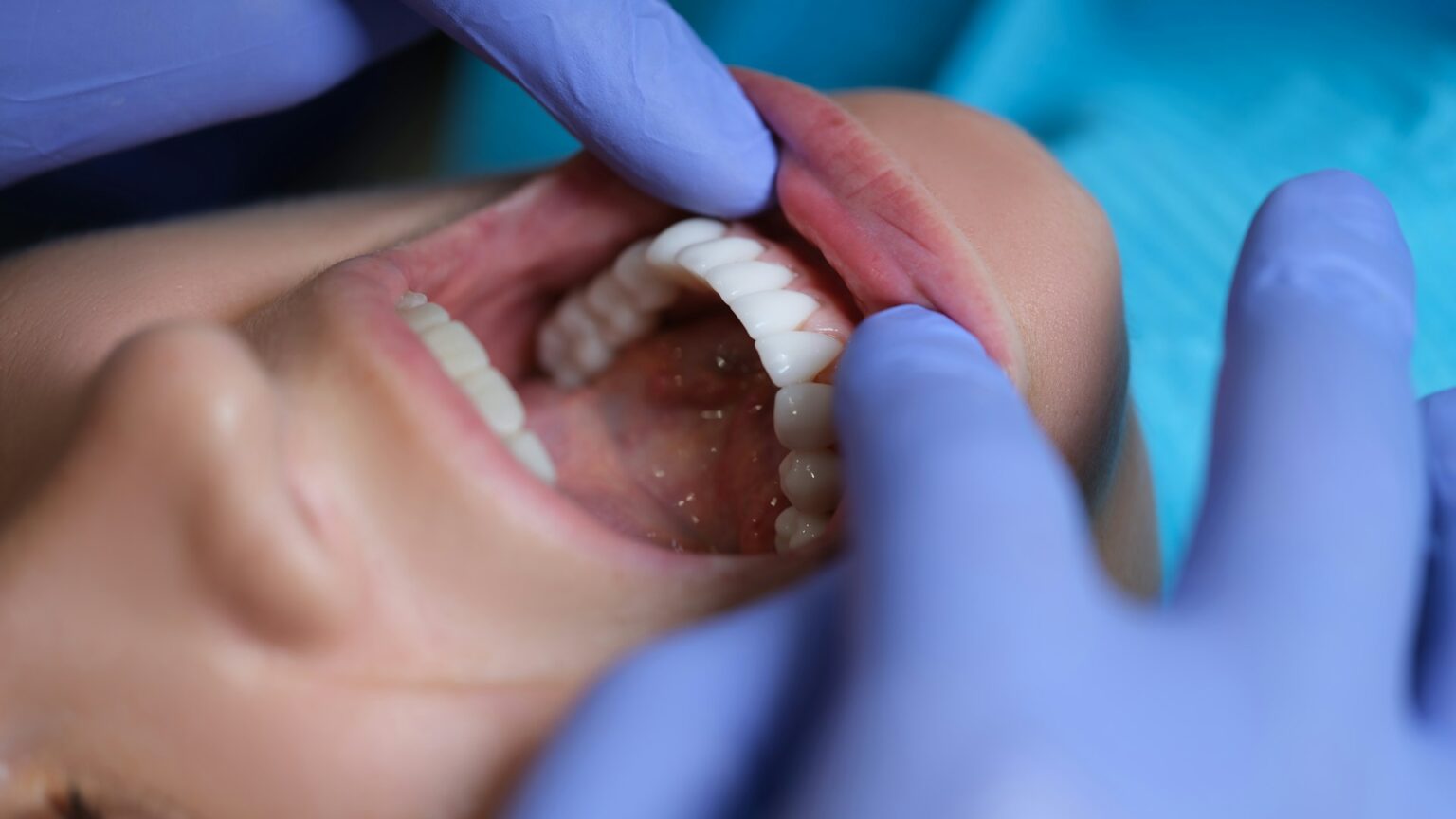 How Dental Veneers Improve Your Smile for a Brighter, Confident Look