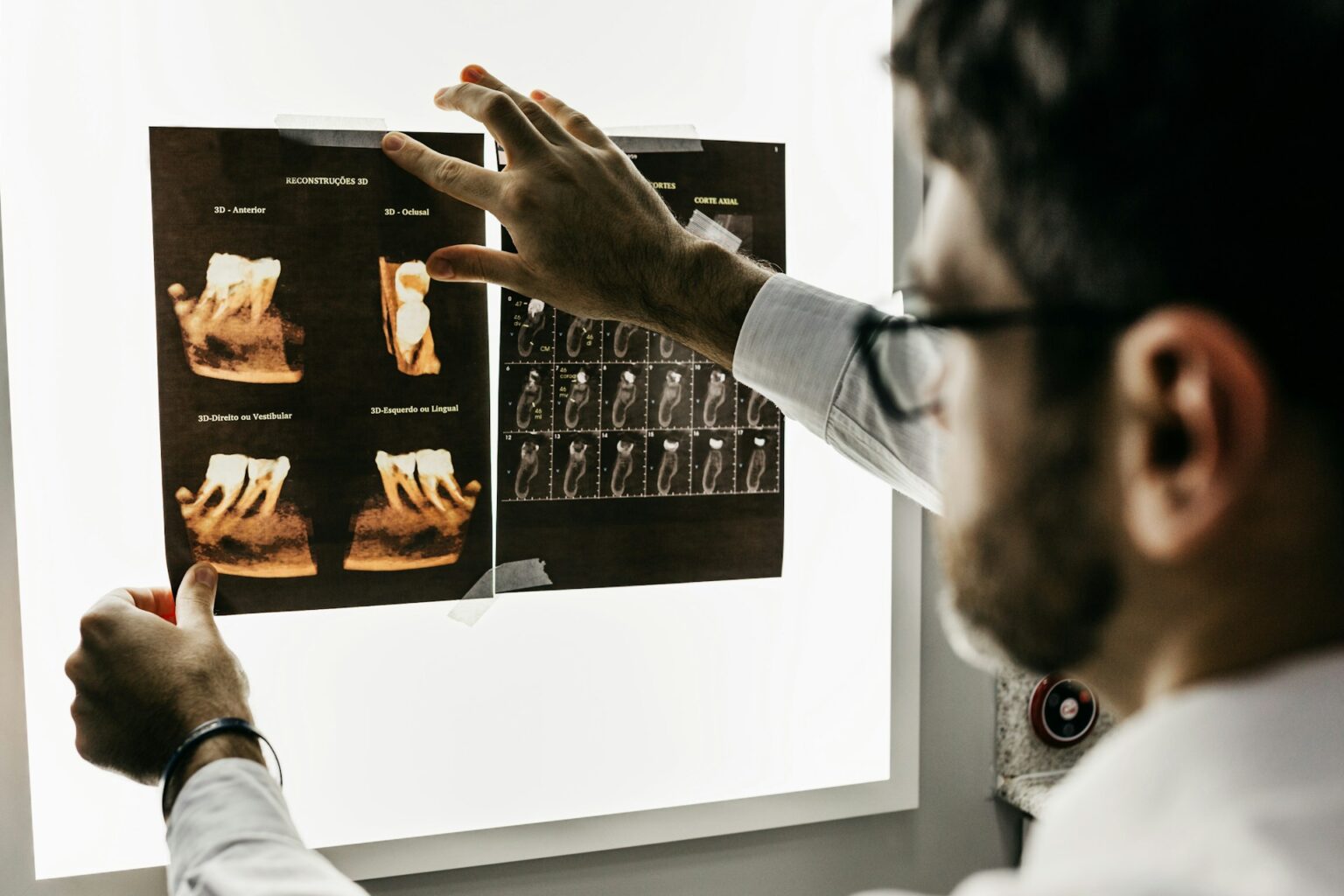 Dental Implants vs Bridges: What’s Better for Your Smile and Budget?