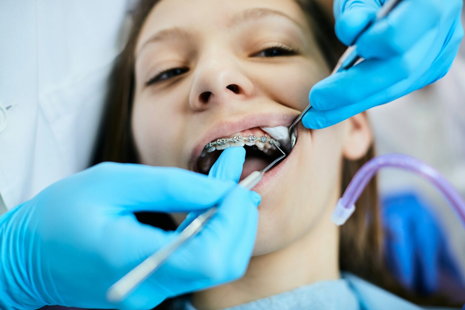 How Are Overbites Fixed? Treatments to Improve Your Smile